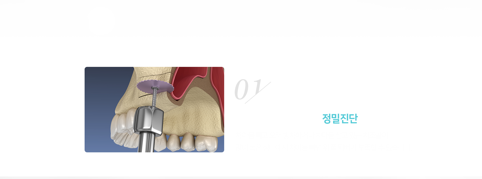 1단계-임플란트-시술을-위한-정밀진단-치아를-빼고-오래-방치하거나-치아를-잡고-있는-치조골이-많이-녹은-상태에서-치아를-빼면-위쪽-턱뼈가-부족할-수-있습니다